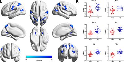 Altered Static and Dynamic Interhemispheric Resting-State Functional Connectivity in Patients With Thyroid-Associated Ophthalmopathy